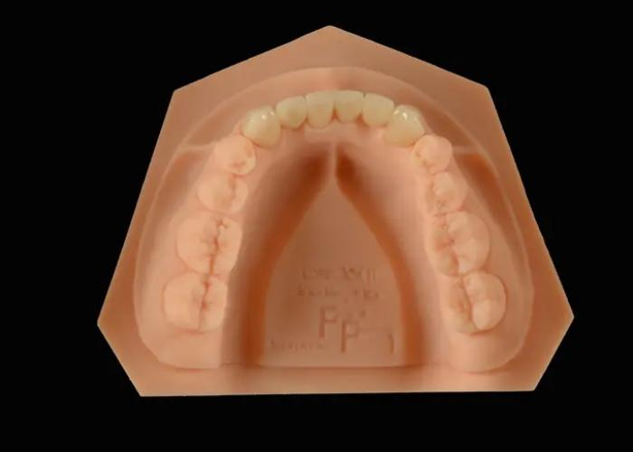 Enhancing Oral Functionality and Aesthetics: The Role of E-Max Dental Bridge